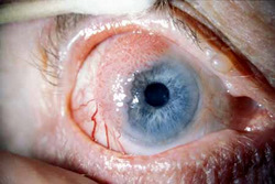 eye showing larger localised dysplastic lesions