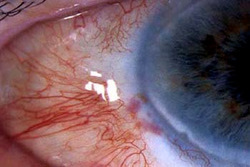 eye showing Large Dysplasia after excision