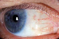 eye showing Small dysplasia after excision