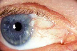 eye showing Small dysplasia before excision