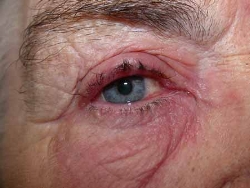 Allergy in eye from MMC