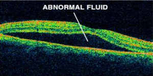csr abnormal fluid diagram