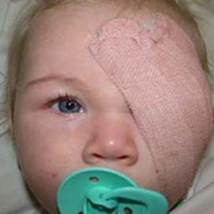 Enucleation – Child