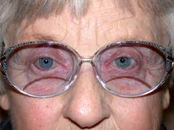 Artificial eye with glasses